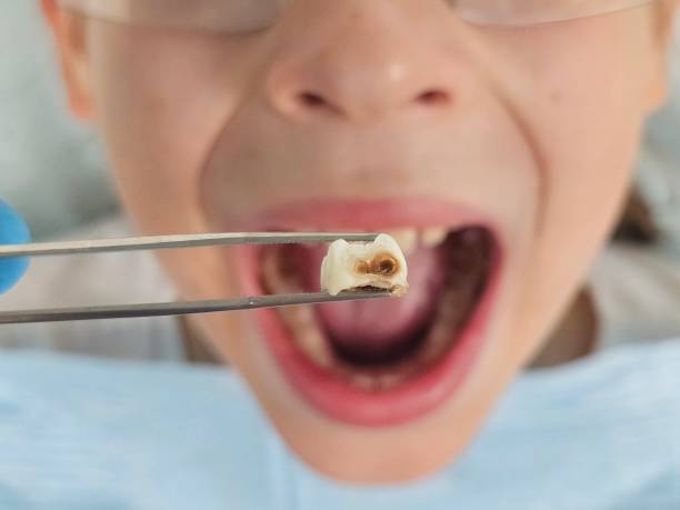 Best Emergency Tooth Extraction in Surf City, NC